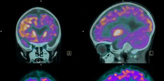Single brain scan predicts tipping point for symptom onset in Alzheimer’s