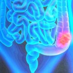 7-MB-Editors Pick-30-09-2021-3-Colorectal cancer-iStock-1256373514