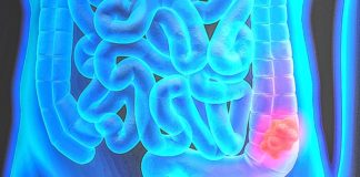 Increased colon cancer risk extends to second- and third-degree relatives