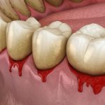 4-MB-Editors Picks214-10-2021-Dental-periodontitis-Teeth-Gums-iStock-1202019645
