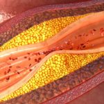 4-MB-Practitioners-21-10-2021-Atherosclerosis-Coronary artery plaque-iStock-610988192