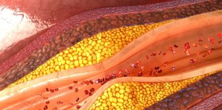Atherosclerosis in more than 40% of Swedish adults with no known heart disease – SCAPIS