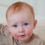 6-MB-Editors Picks-21-1-2021-Atopic dermatitis-baby-boy-skin-rash-iStock-906641842