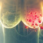 4-MB-Editors Picks-04-11-2021-Breast-cancer-iStock-1138405349
