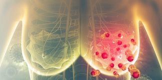 Under-35s have greater risk of breast cancer spreading — Meta-analysis