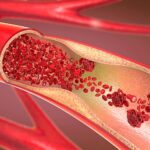 4-MB-Editors Picks-18-11-2021-Coronary artery disease-arteriosclerosis-plaque-iStock-1078217402