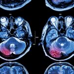 4-MB-Editors Picks-09-12-2021-MRI-Scan-Stoke-Tumour-iStock-485852374