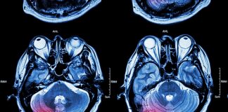 Emotional upset and heavy physical exertion as stroke triggers — Interstroke study