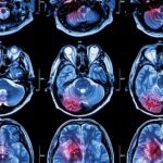 6-MB-Editors Picks-17-02-2022-MRI-Scan-Stoke-Tumour-iStock-485852374