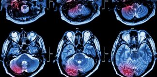 Strokes in COVID-19 patients associated with higher disability and death risk