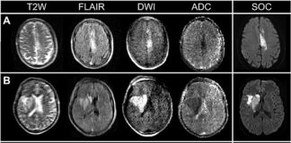 Portable MRIs almost as effective as standard MRIs in detecting strokes