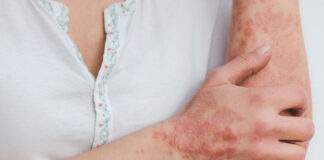 Psoriasis study shows promising new treatment strategy