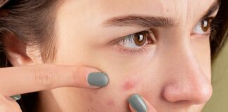 How skin oil turns infection-fighting cells into accomplices, making acne bacteria thrive – US study