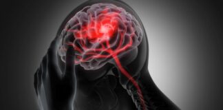 ‘Mini-strokes’ need urgent assessment and follow-ups – AHA