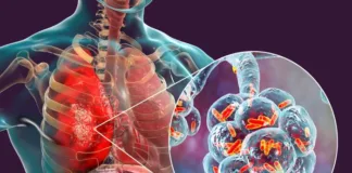 Treatment gaps and poor governance hold back progress in reducing TB