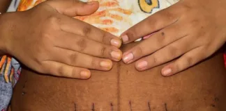 Scientists identify Caesarean scar disorder