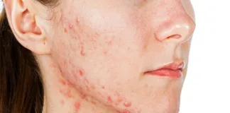 Cheap BP drug could treat acne – Southampton study