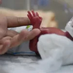 New born baby treated in incubator.