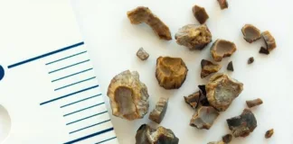 Added sugars may raise kidney stone risk – Chinese study