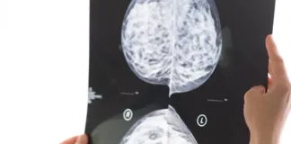 Swift detection of cancer in mammograms by AI – Swedish study