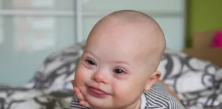 Low rate of Down’s syndrome screening in SA , say experts