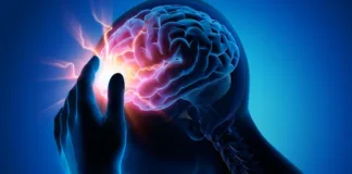 Ibuprofen less effective than other drugs for migraine attacks – US study