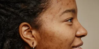 Experts advise monitoring of acne drug’s adverse psychiatric effects