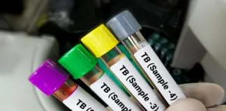 Most TB patients don't have persistent cough – global study