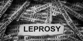 Leprosy persists in South Africa despite 'elimination' status – 20-year study