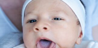 Paediatric group flags baby tongue-tie op ‘epidemic’