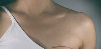 Double mastectomy no guarantee against cancer – Canadian cohort study