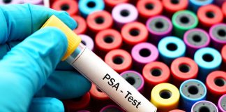 At-home prostate cancer spit test effective – UK study