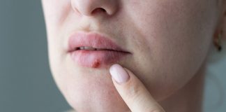 Link between Alzheimer’s and cold sores emerges in new data