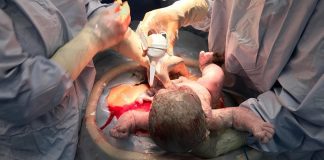Planned C-sections tied to childhood cancer risk – Swedish cohort study