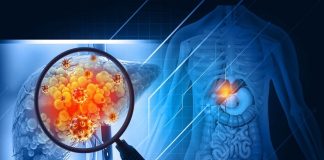 Most liver cancer preventable, Lancet Commission finds