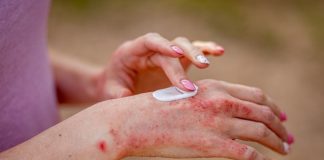 Steroid-free cream for hand eczema approved by FDA