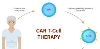 First MS patient gets CAR T-cell therapy in UK trial
