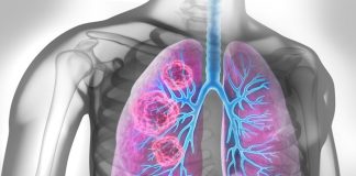 Why screening for the deadliest cancer misses most cases – US study