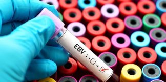 Strong evidence that Epstein-Barr could be the culprit behind lupus