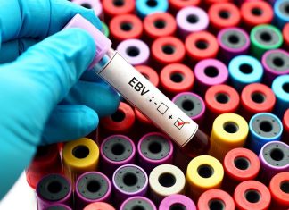 Strong evidence that Epstein-Barr could be the culprit behind lupus