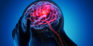 Experts flag headache in 46% of haemorrhagic stroke cases