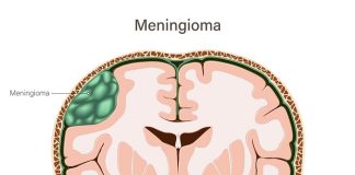 Experts call for SA lens on contraceptive link to meningioma