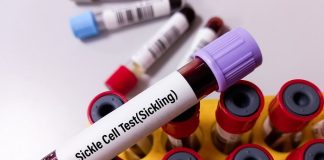 Breakthrough sickle cell gene therapy a distant hope in Africa