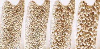 Higher risk of osteoporosis and gout with GLP drugs – US study