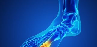 Big toe osteoarthritis? Don’t wait to operate – Finnish study