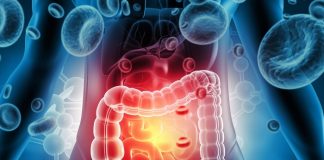 Long-term study focuses on colorectal cancer in young South Africans