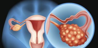 Fallopian tube removal slashes ‘ovarian cancer’ risk by 80%
