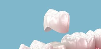 Dental crown of the future could be 3D-printed while you wait