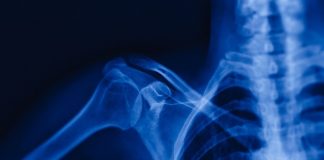 Rethinking treatment of common shoulder pain – Australian review