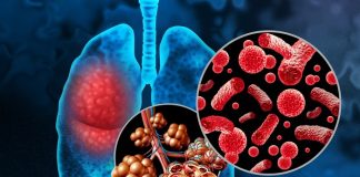 Pneumonia may reveal undiagnosed blood cancer – Swedish study